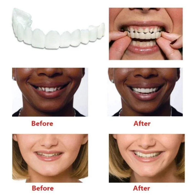 Denture Cover Veneer Snap-on T - Teeth Whitening Kit ulasan dan harga
