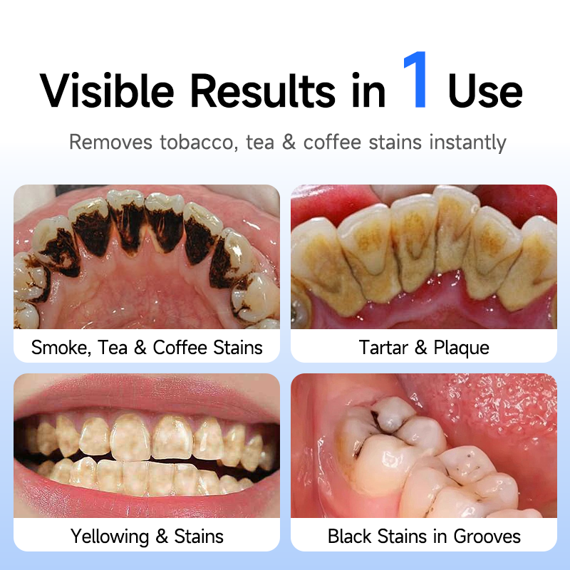 Electric Tooth Polisher Low No - Teeth Whitening Uk ulasan dan harga